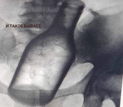 Монеты, бутылки и батарейки извлекали из пациентов врачи Пятигорска в 2025 году